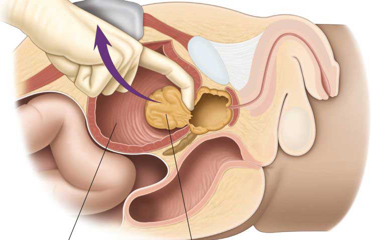 Open Prostatectomy