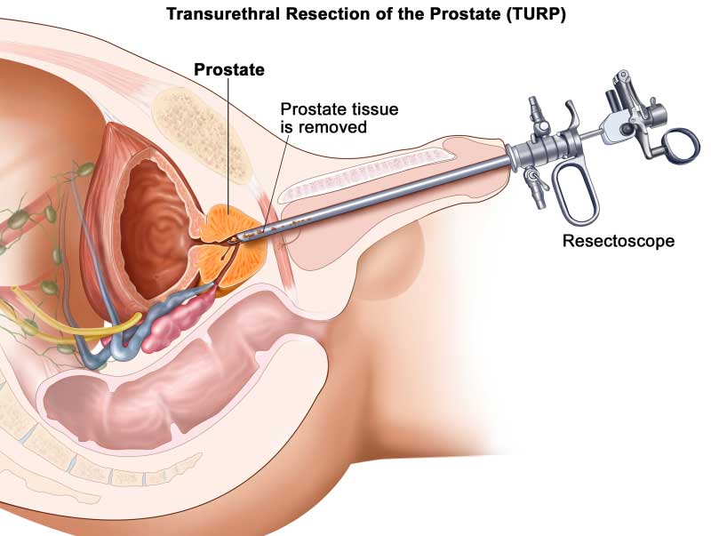 Traditional Surgery (TURP)