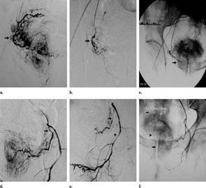 Prostatic Artery Embolization