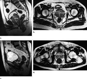 Prostatic Artery Embolization