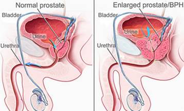prostate-gland-calculator.jpg